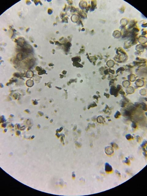 Biscogniauxia mediterranea spores at 2000x magnification in a KOH mount, confirming the charcoal canker diagnosis